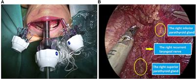 Case Report: Transoral Endoscopic Thyroidectomy via Vestibular Approach in Pediatric Thyroid Cancer